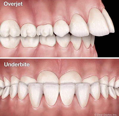 Common Type of Headgear