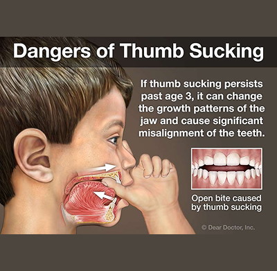 Dangers of Thumb Sucking - Weisner Orthodontics in Massachusetts