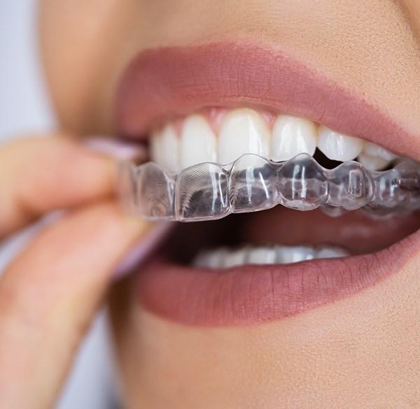 An Aligner Just for Teens