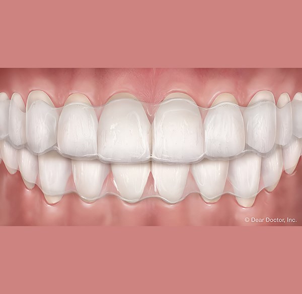 Clear Aligners for teens - Weisner Orthodontics in Massachusetts
