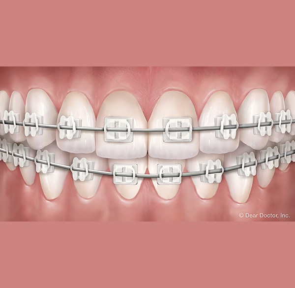 Clear Braces - Weisner Orthodontics in Massachusetts