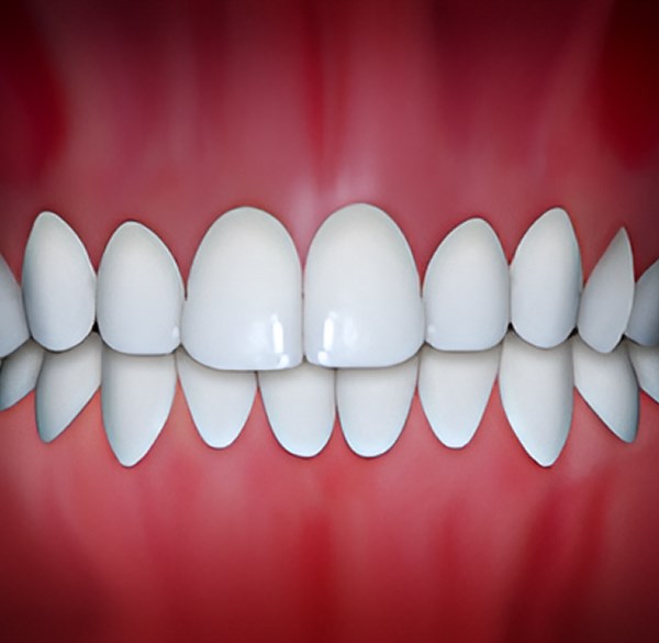 Dental Midlines not Matched