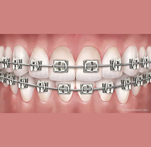 Metal Braces - Weisner Orthodontics in Massachusetts