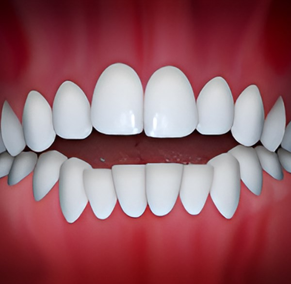 Openbite Treatment by Weisner Orthodontics in Massachusetts