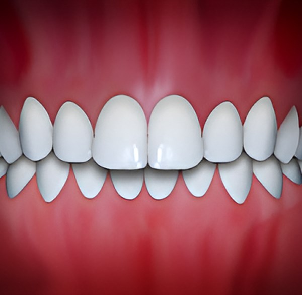 Overbite - Weisner Orthodontics in Massachusetts