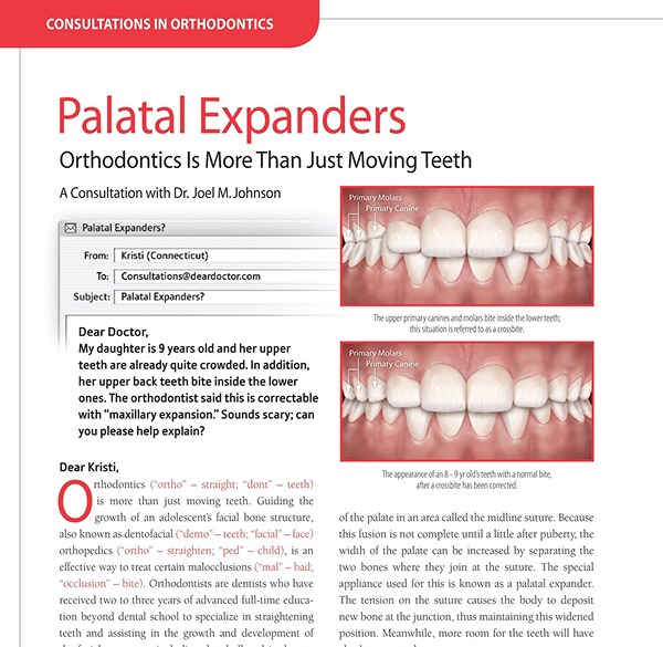 Palatal Expanders
