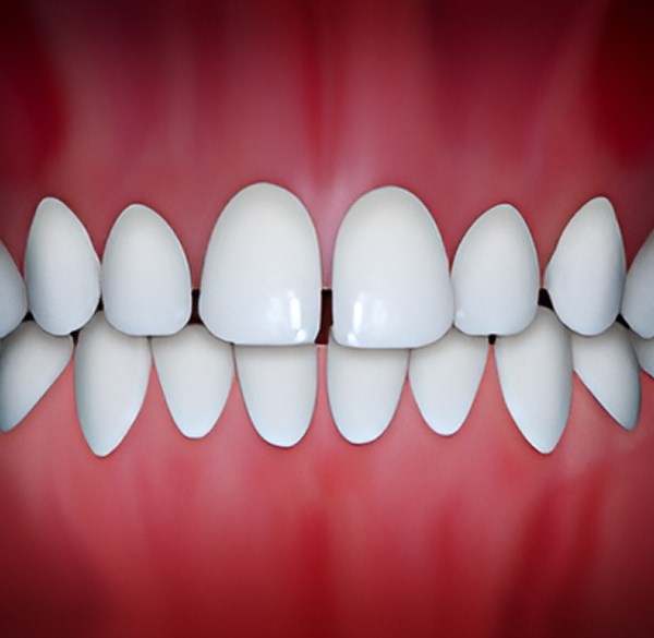 Spacing Treatment by Weisner Orthodontics in Massachusetts