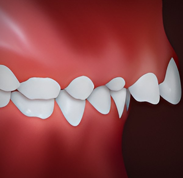 Upper Front Teeth Protrusion - Weisner Orthodontics in Massachusetts