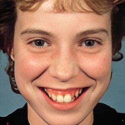 A retruding chin (one that is too far back)