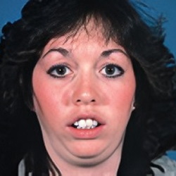 An inability to achieve lip contact when the lips are relaxed