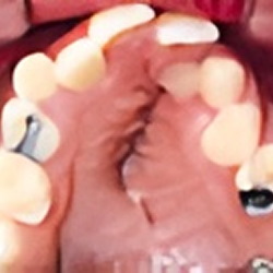 Asymmetry (facial imbalance)