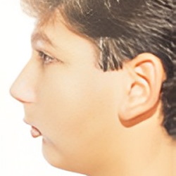 Cleft palate (in young children)