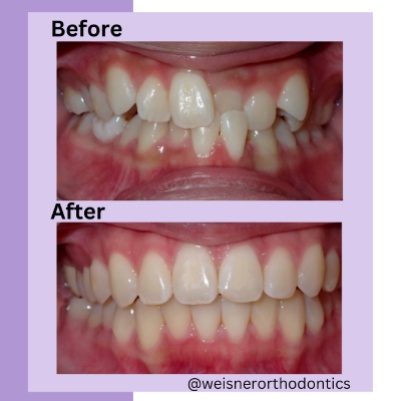 Before and After